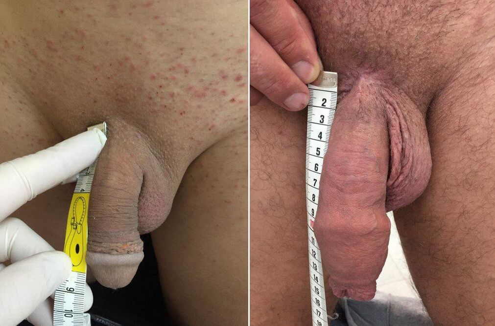 pred a po operačnom zväčšení penisu