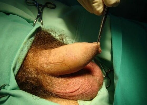 chirurgický zákrok na zväčšenie penisu